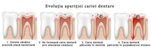 evolutia-aparitiei-cariei-dentare