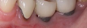 risc implant dentar